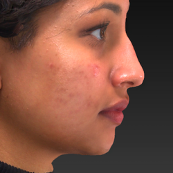 Rhinoplasty Before & After Patient #2826