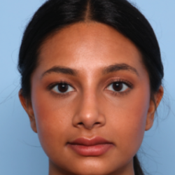 Rhinoplasty Before & After Patient #2808