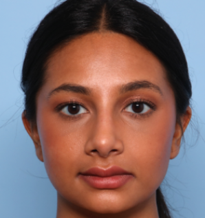 Rhinoplasty Before & After Patient #2808