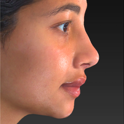 Rhinoplasty Before & After Patient #2826