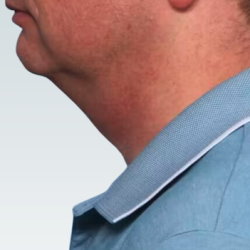 Facelift Before & After Patient #2844