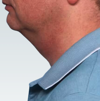 Facelift Before & After Patient #2844