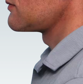 Facelift Before & After Patient #2844