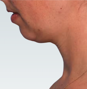 Facelift Before & After Patient #2862