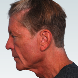Facelift Before & After Patient #2845