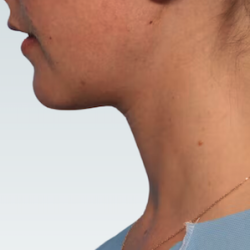 Facelift Before & After Patient #2862