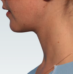 Facelift Before & After Patient #2862