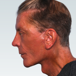 Facelift Before & After Patient #2845