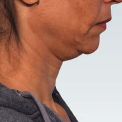 Facelift Before & After Patient #2863