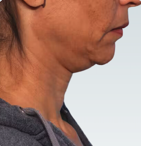 Facelift Before & After Patient #2863