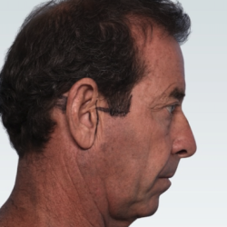 Facelift Before & After Patient #2846