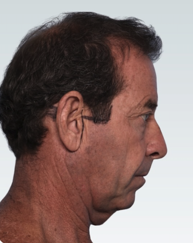 Facelift Before & After Patient #2846