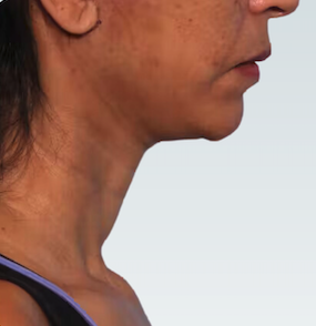 Facelift Before & After Patient #2863