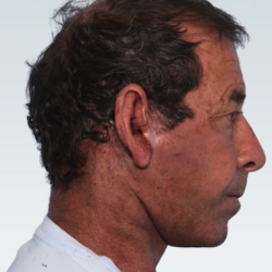 Facelift Before & After Patient #2846
