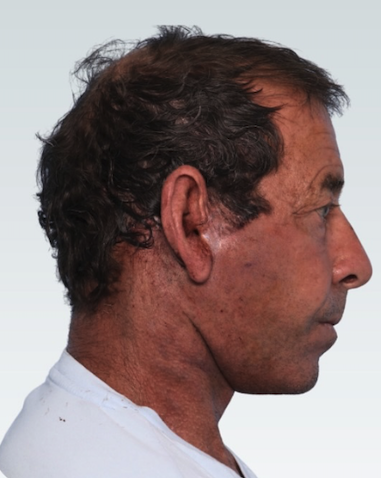 Facelift Before & After Patient #2846