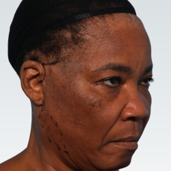 Facelift Before & After Patient #3025