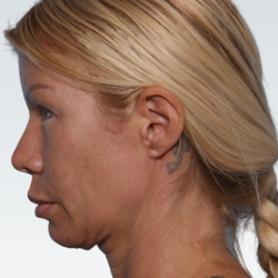 Facelift Before & After Patient #3065