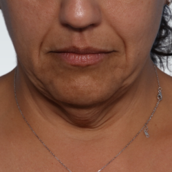 Facelift Before & After Patient #3070