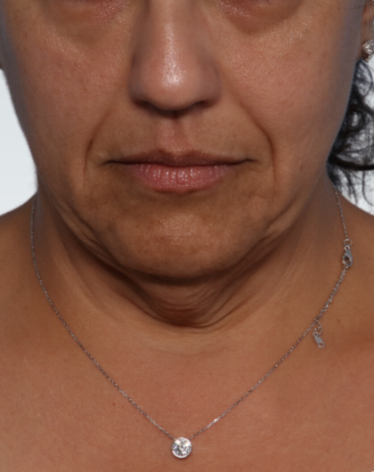 Facelift Before & After Patient #3070