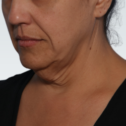 Facelift Before & After Patient #3075