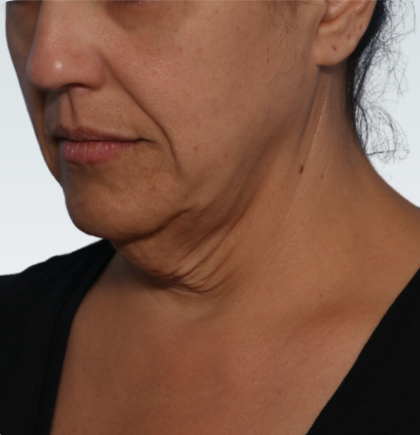 Facelift Before & After Patient #3075