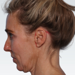 Facelift Before & After Patient #2990