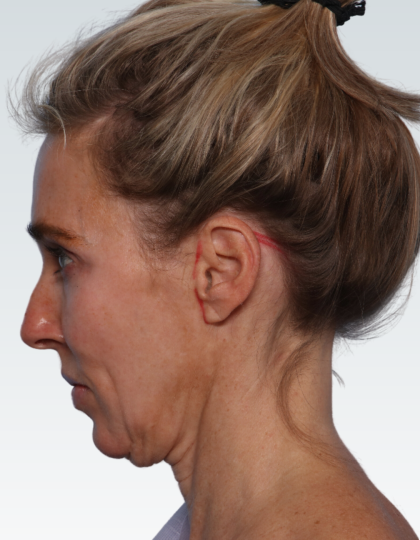 Facelift Before & After Patient #2990