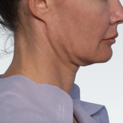 Facelift Before & After Patient #3030