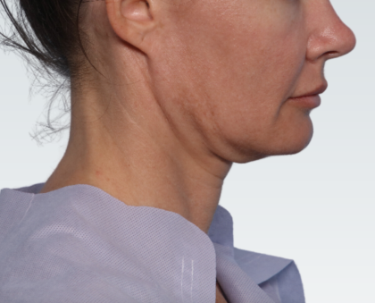 Facelift Before & After Patient #3030