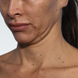 Facelift Before & After Patient #3047