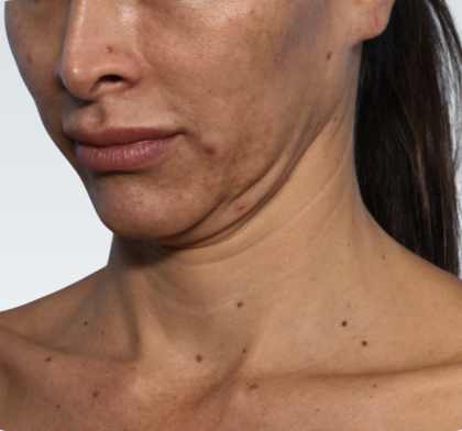 Facelift Before & After Patient #3047