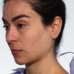 Facelift Before & After Patient #3050