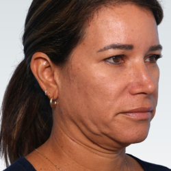 Facelift Before & After Patient #3053
