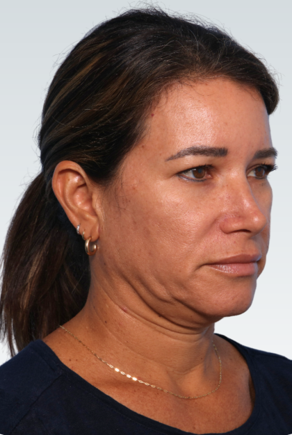Facelift Before & After Patient #3053
