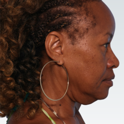Facelift Before & After Patient #3056
