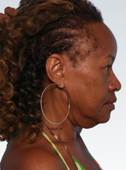 Facelift Before & After Patient #3056