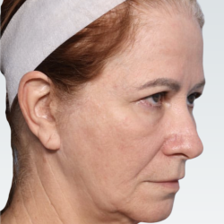Facelift Before & After Patient #3059