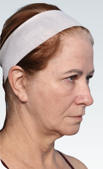 Facelift Before & After Patient #3059