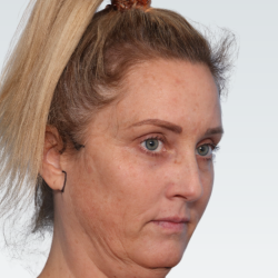 Facelift Before & After Patient #3062