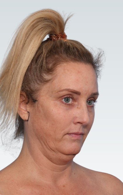 Facelift Before & After Patient #3062