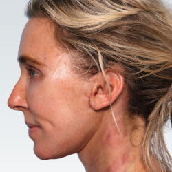 Facelift Before & After Patient #2990
