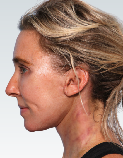 Facelift Before & After Patient #2990