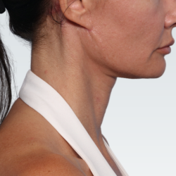 Facelift Before & After Patient #3030