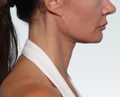 Facelift Before & After Patient #3030