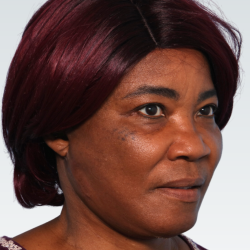 Facelift Before & After Patient #3025