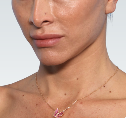 Facelift Before & After Patient #3047