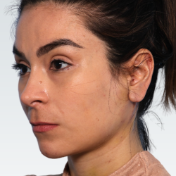Facelift Before & After Patient #3050