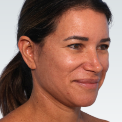 Facelift Before & After Patient #3053