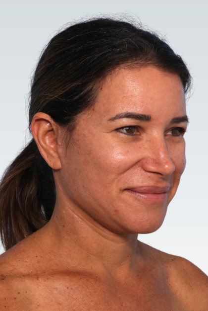 Facelift Before & After Patient #3053
