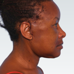 Facelift Before & After Patient #3056